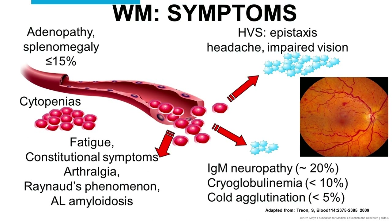 Experienced- Living Longer with WM with Dr. Prashant Kapoor