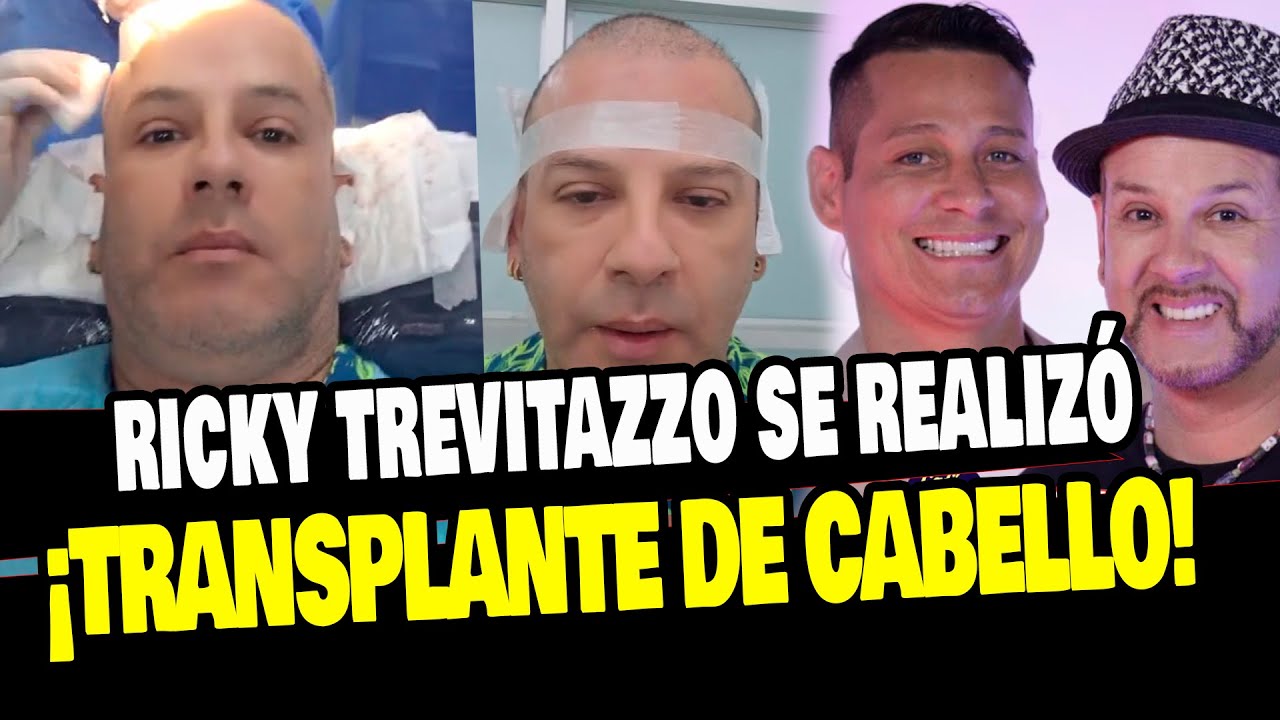 RICKY TREVITAZZO SE REALIZA TRANSPLANTE DE CABELLO TRAS QUEDARSE CALVO