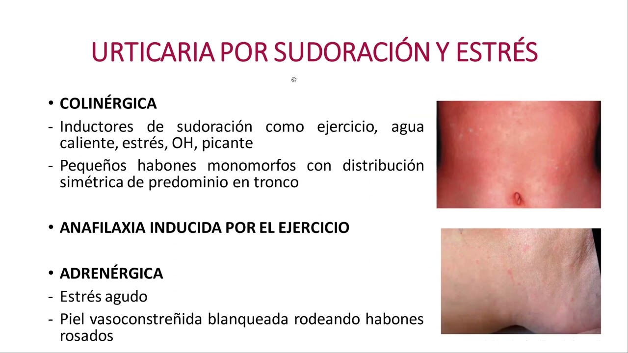 Urticaria. Definición y formas clínicas.