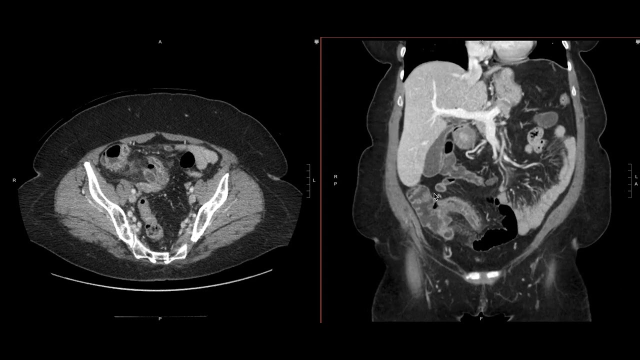 Abdominal Imaging Call Prep Cases: Perforated Appendicitis (CT) Search Pattern