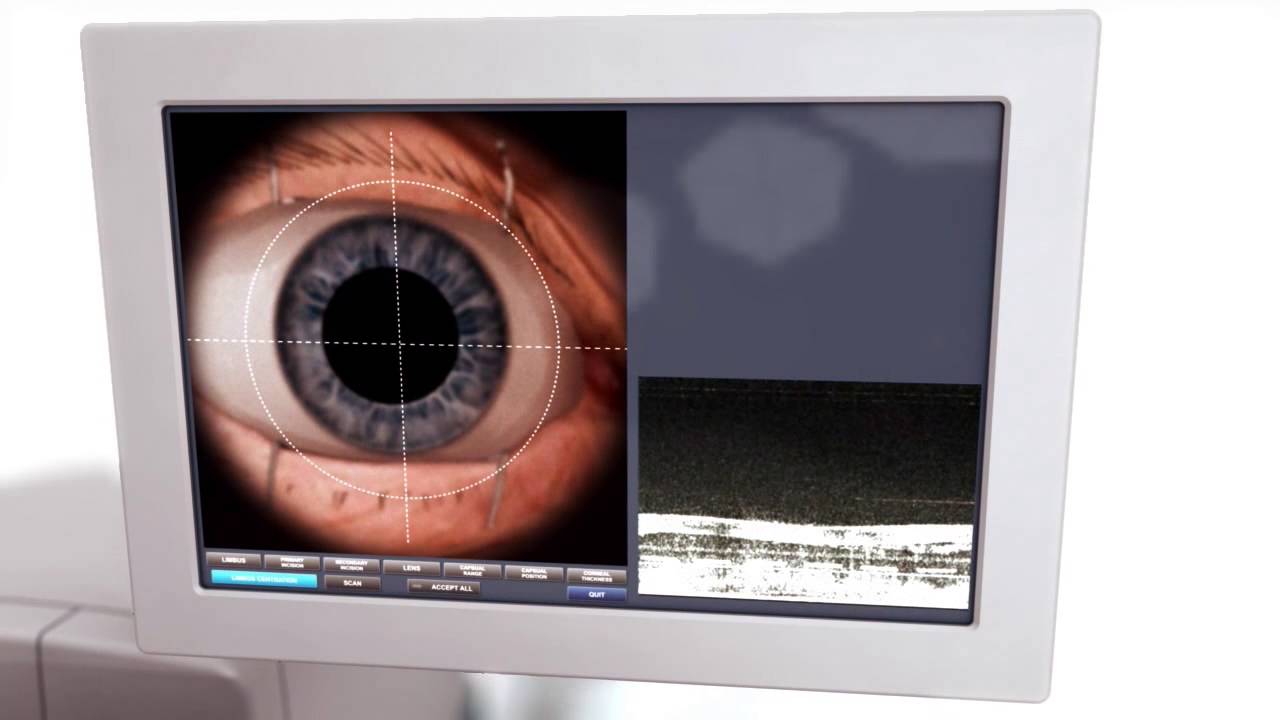 Bladeless Laser Cataract Surgery in Bradenton & Sarasota &ndash; The Eye Associates
