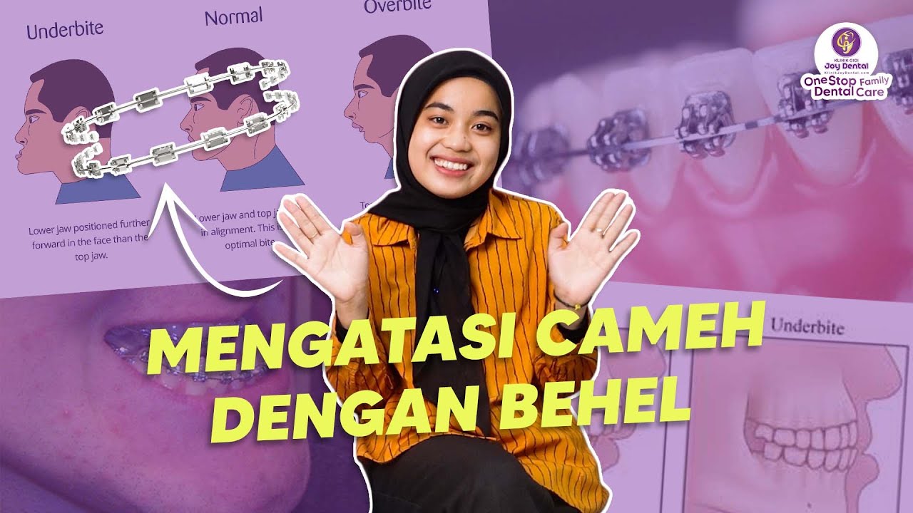 Gigi Kamu Cameh / Underbite? Inilah penyebab dan solusinya