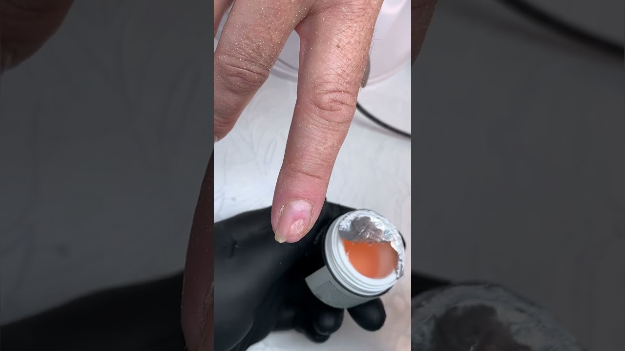 Онихолизис. Протезирование ногтей. Дизайн ногтей. Гель лак.