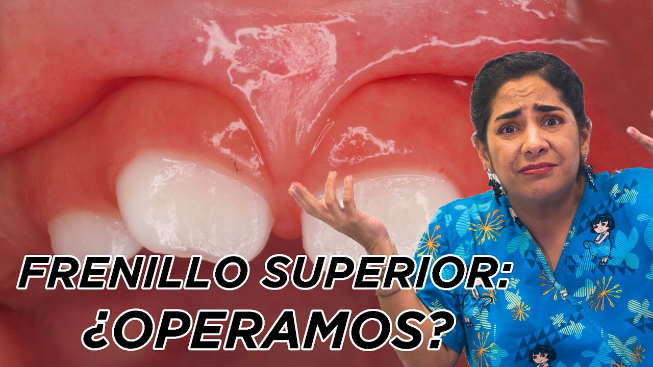 CASO REAL: ¿Se opera el frenillo superior?