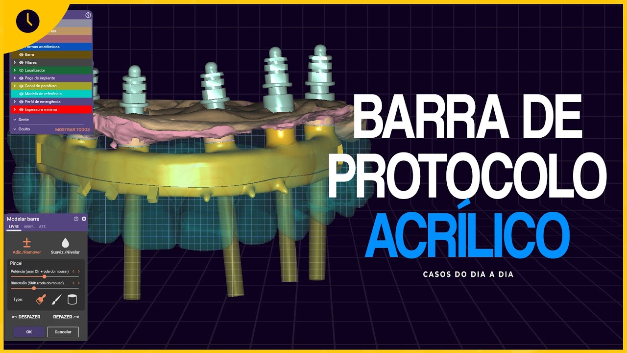 EXOCAD : Barra de protocolo acrílico
