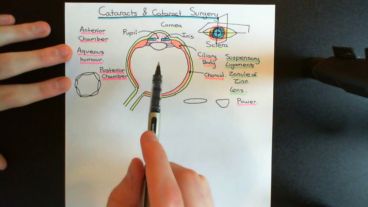 Cataracts and Cataract Surgery Part 1
