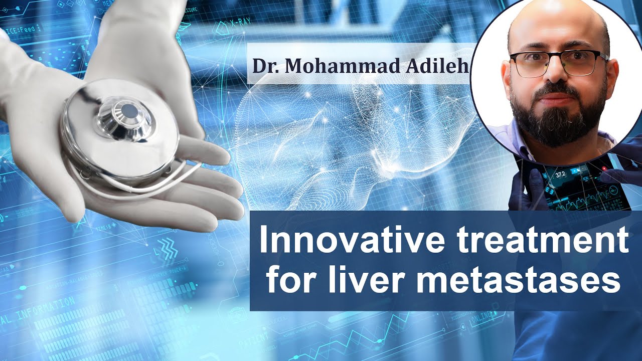 Hepatic artery infusion: an innovative treatment for liver metastases