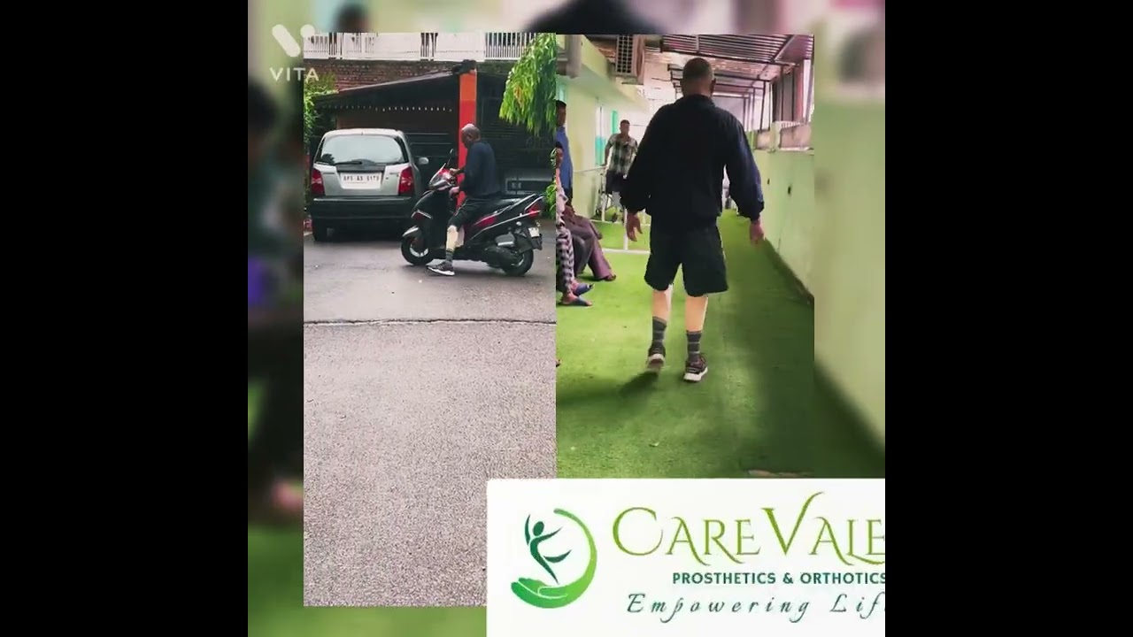 Bilateral Below knee Amputee walking | CareVale #artificialleg #belowknee #prosthetics #empowerment