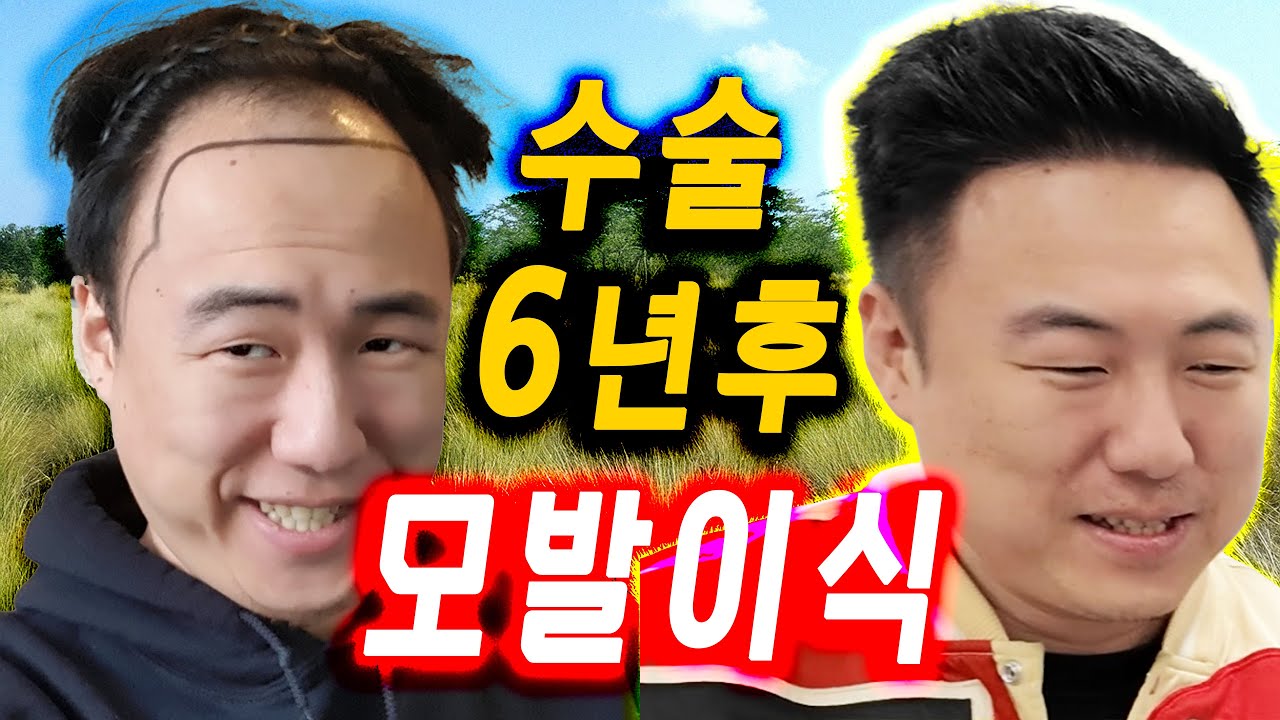 모발이식 수술 6년 경과 현재 상태 보고드립니다.|남성형 M자탈모 대량모발 이식 수술  탈모약? 발기부전? , 삶이 어떻게 바뀌었는가? -대머리독수리의 탈모이야기