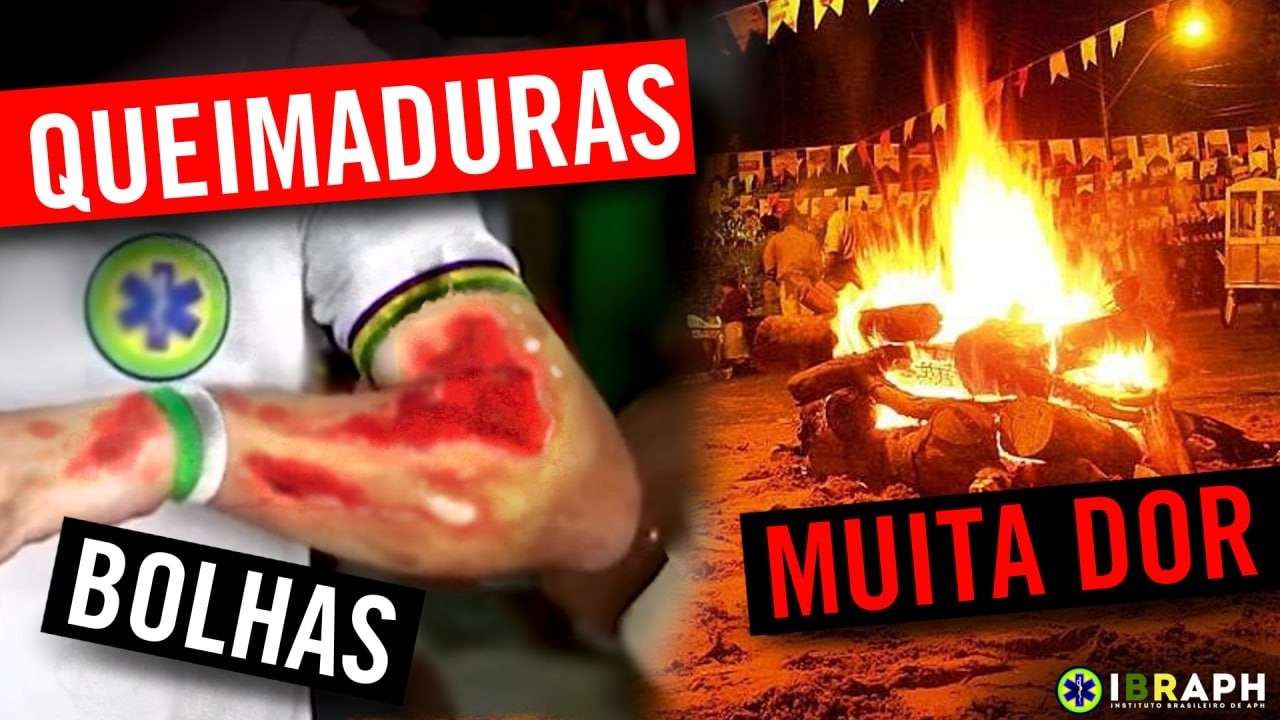 QUEIMADURAS: Tipos, CONDUTAS e Quando Ligar para O SAMU? | Primeiros Socorros