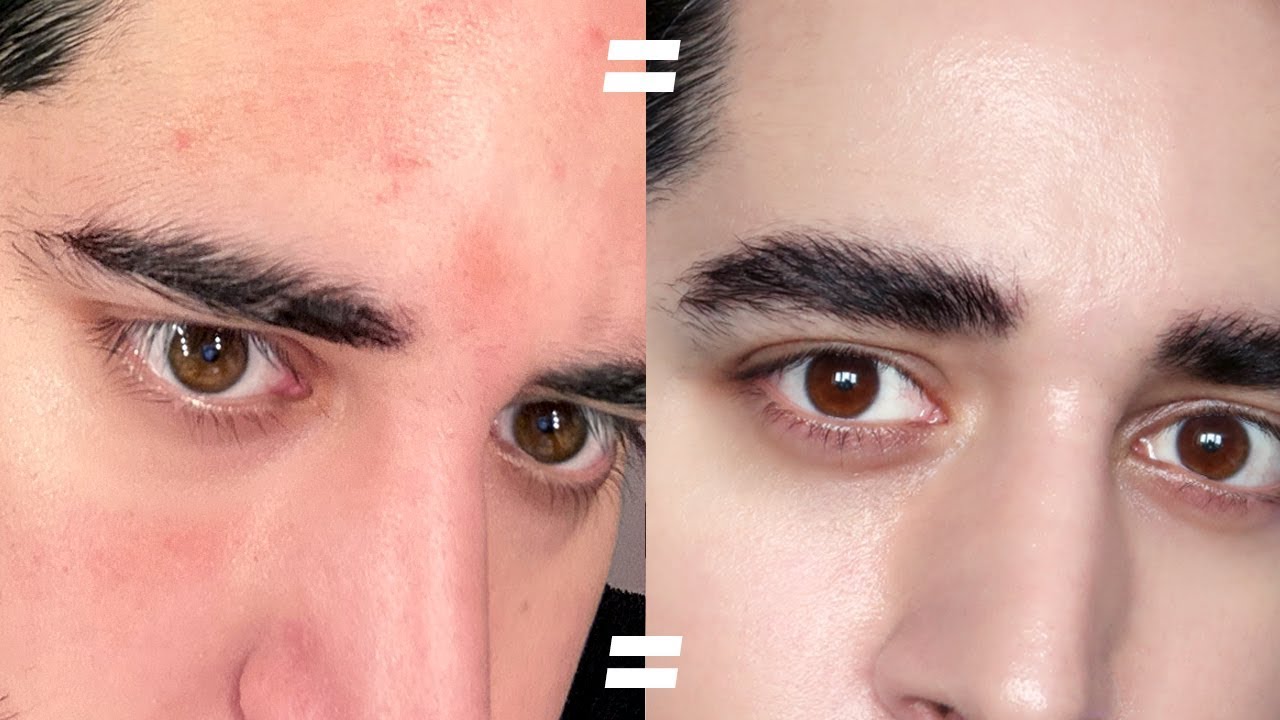Heal And Sooth Damaged, Irritated, Sensitive Skin. Skincare Routine For Irritated Skin ✖ James Welsh