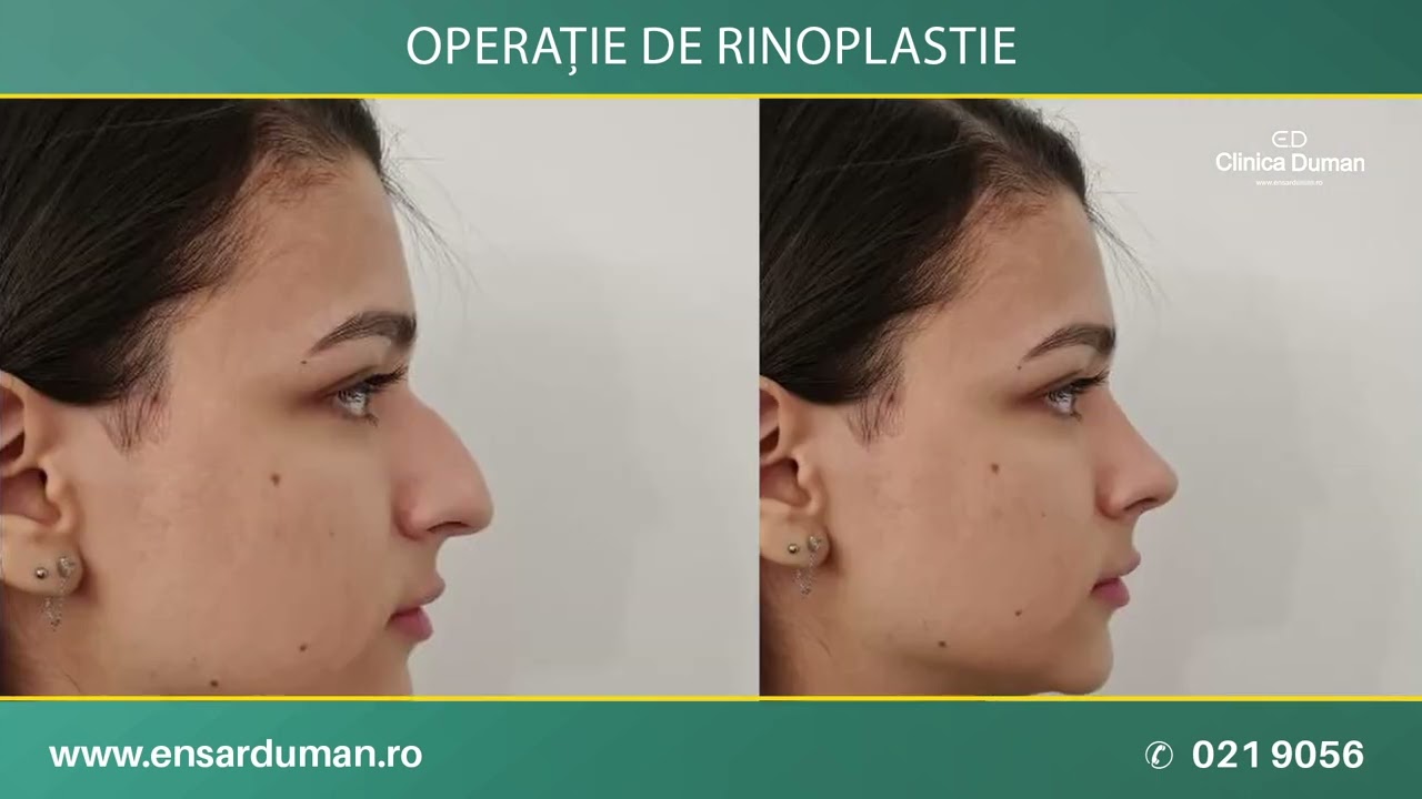 CUM MĂ SIMT DUPĂ OPERAȚIA DE RINOPLASTIE DIN TURCIA