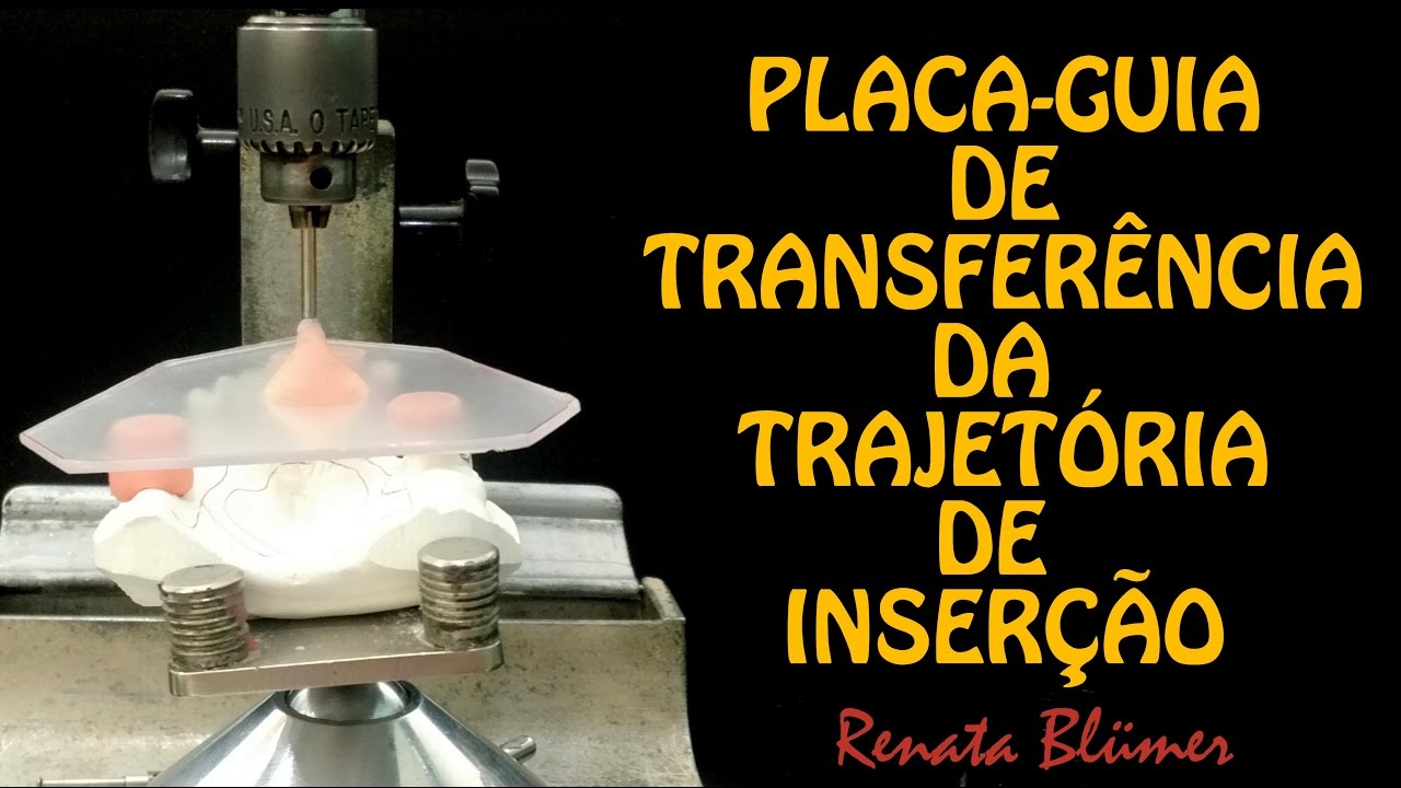 GUIA DE TRANSFERÊNCIA DA TRAJETÓRIA DE INSERÇÃO - PRÓTESE PARCIAL REMOVÍVEL *