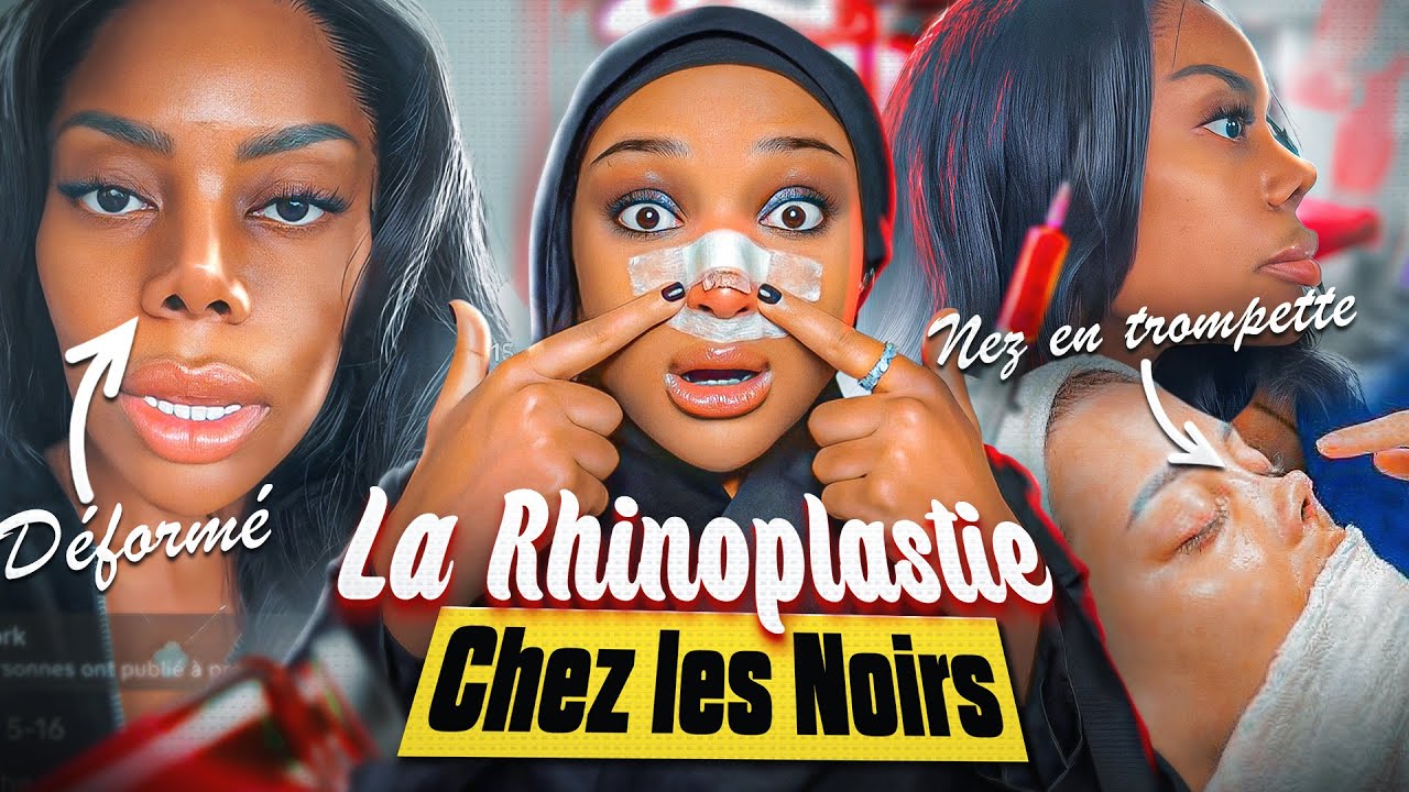 Les NOIRS et les NEZ REFAIT : ÉCHEC ou RÉUSSITE 