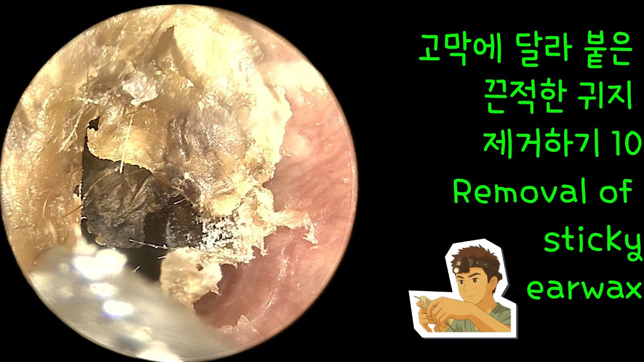 고막에 달라 붙은 끈적한 귀지 제거하기 10 (Removal of sticky earwax)