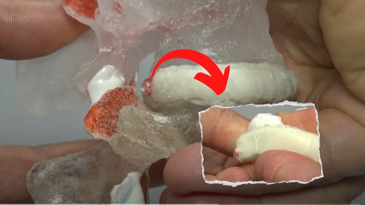 Herniated Disc & Disc Bulging - Easy Explained: Dr. Stuart McGill