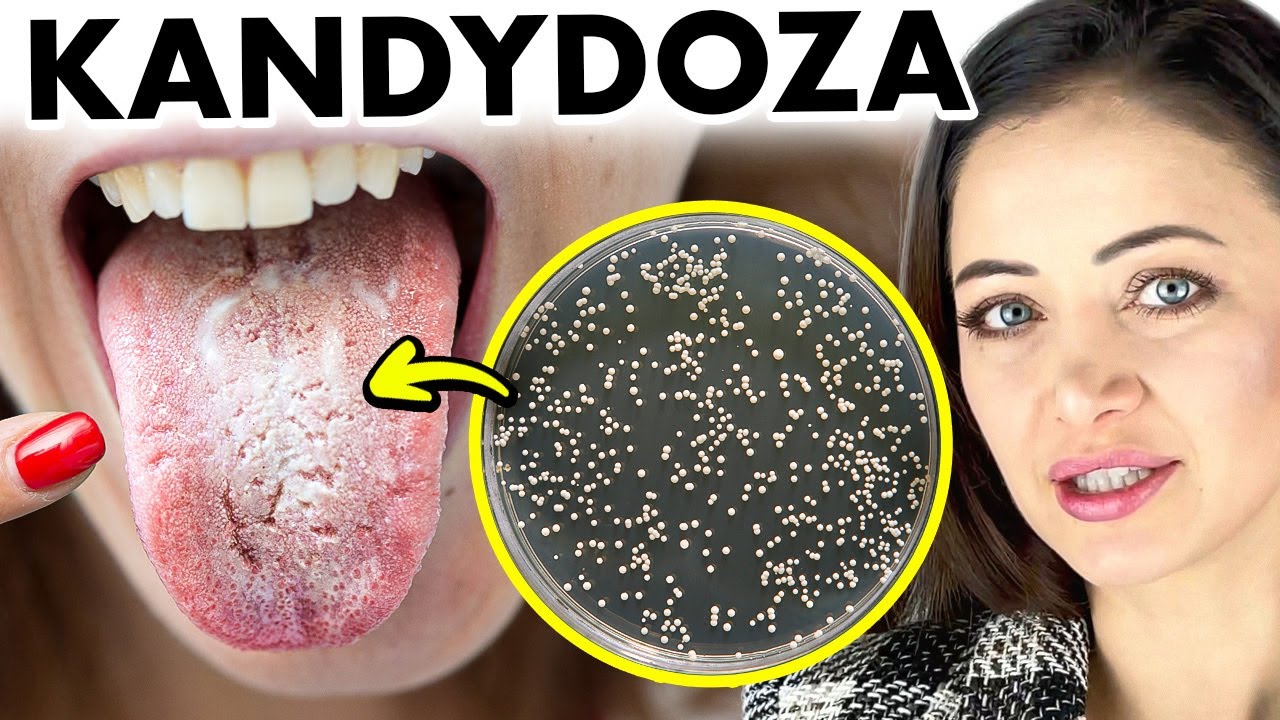 To jedz, a tego unikaj, by zapobiec grzybicy ⭕ Candida albicans