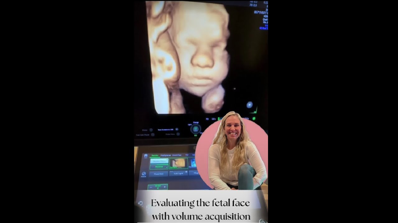 Evaluating the fetal face with volume acquisition