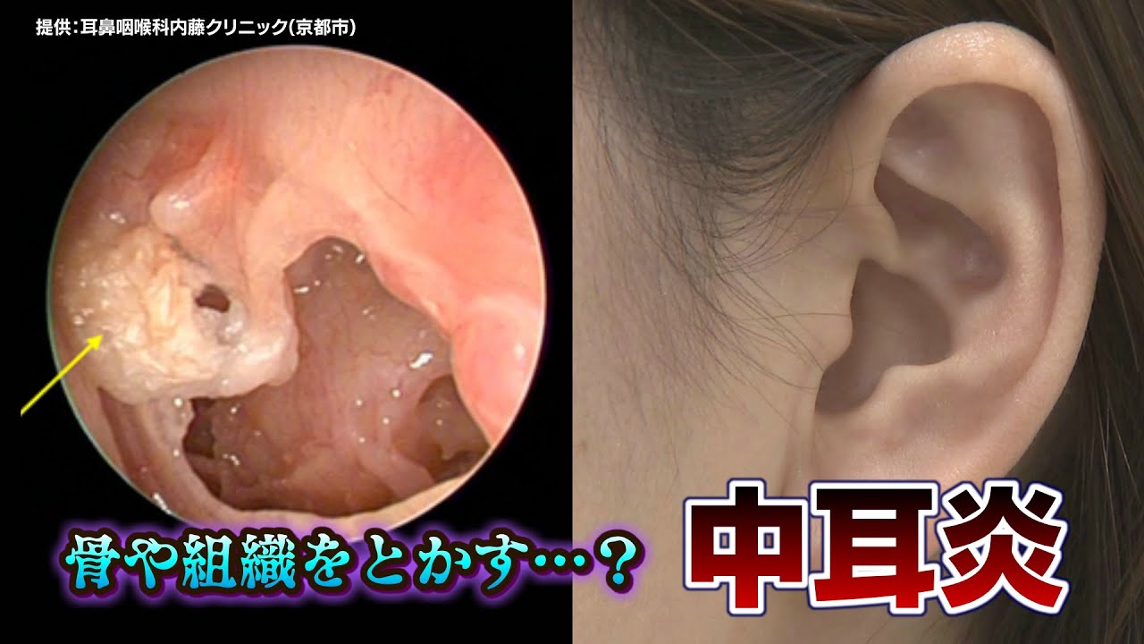 「徐々に周りの骨を溶かして…」放っておくと危険な “中耳炎”　子どもから大人まで年間約27万人が罹患