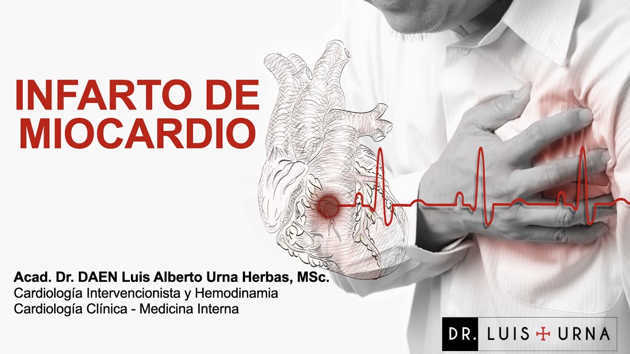 Infarto de miocardio, basado en la Cuarta Definici&oacute;n Universal de Infarto