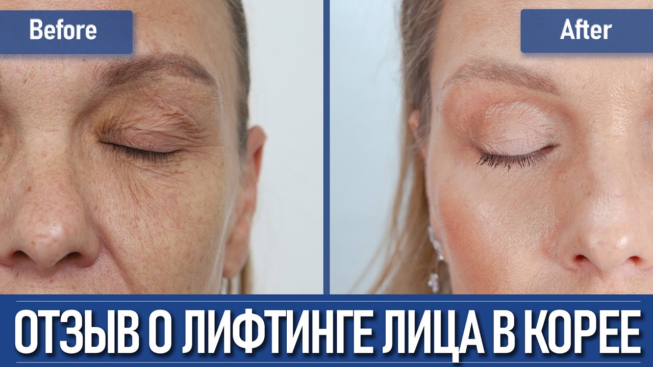 Её лицо до и после операции в Корее — настоящая трансформация!