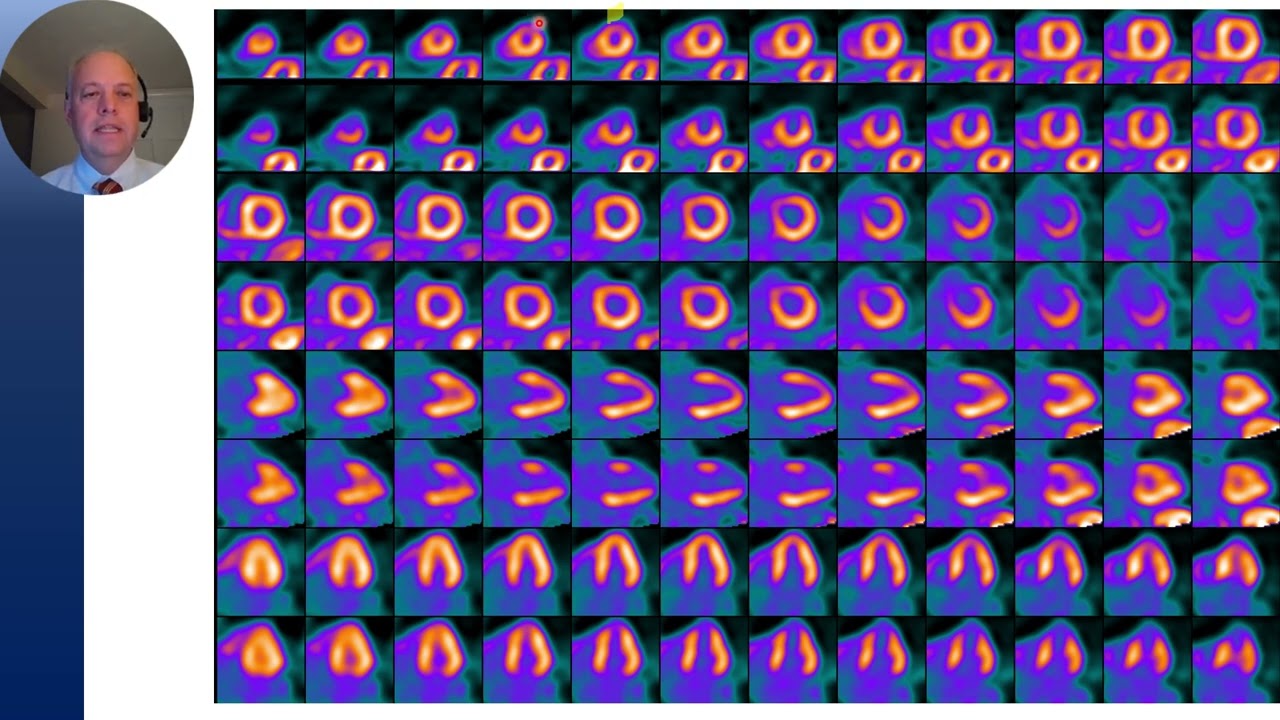 Common Artifacts with Cardiac PET-CT Myocardial Perfusion Imaging: Misregistration