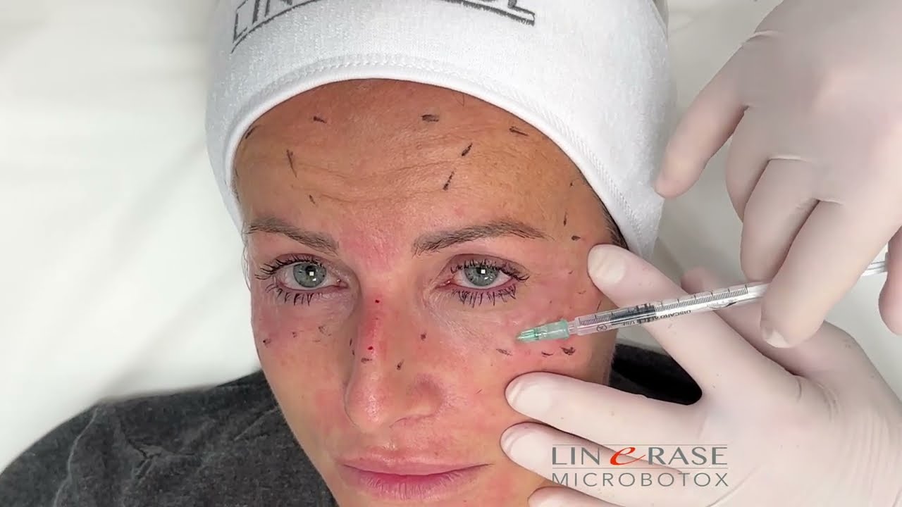 Linerase Microbotox: Surface Wrinkle Treatment