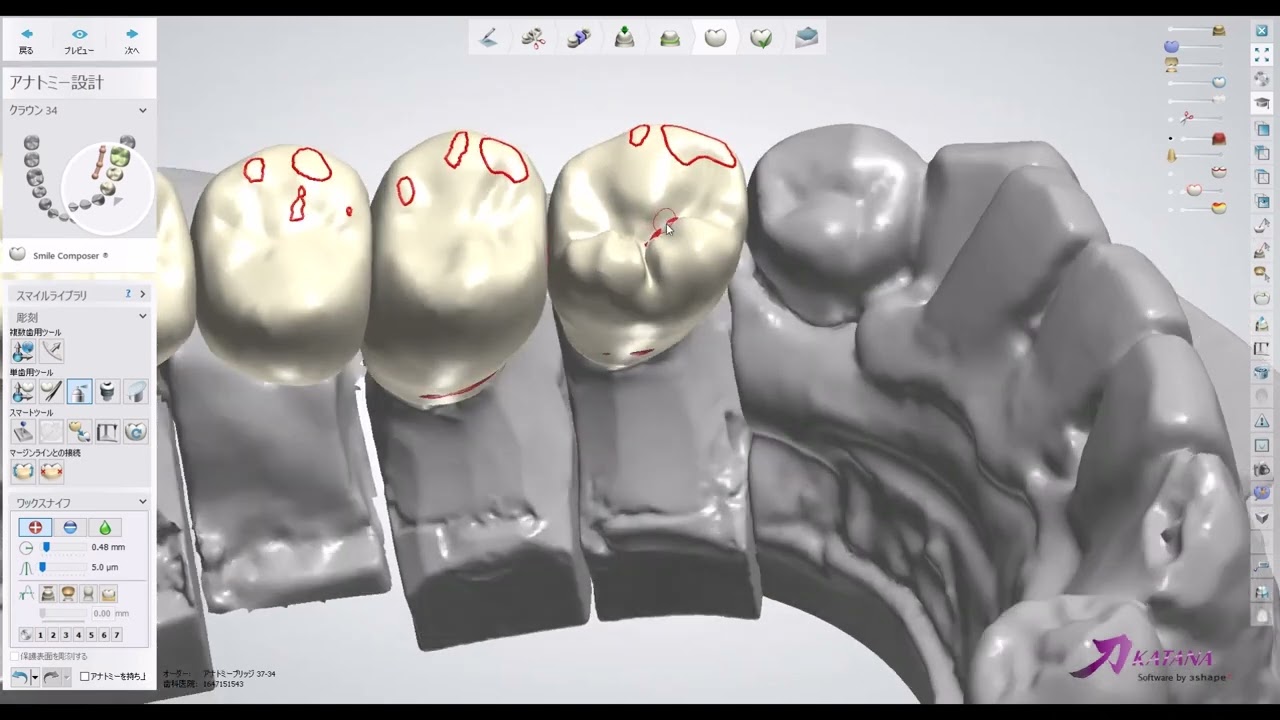 【歯科技工】3Shape 臼歯４本ブリッジのデザイン