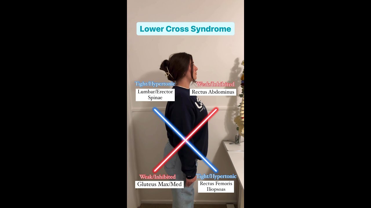 Upper and Lower Cross Syndrome