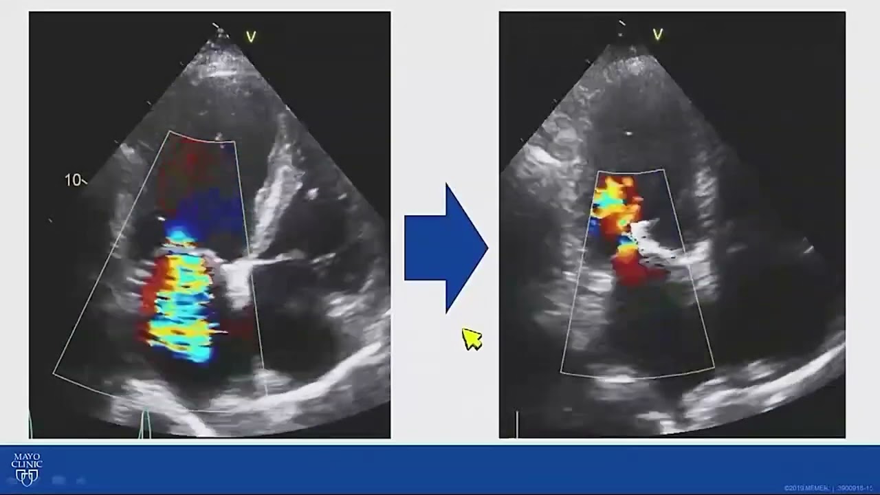Mitral Valve Disease-When to Consider Transcatheter Mitral Valve Intervention