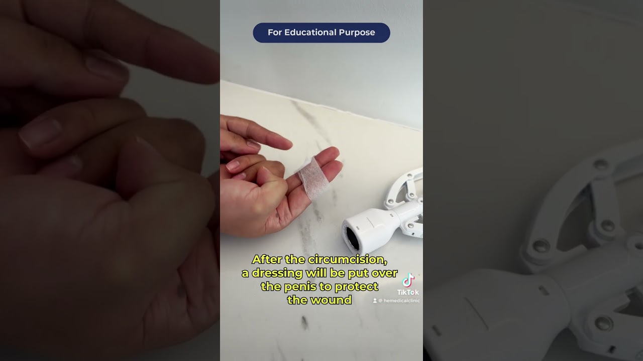 What is the best age range for children stapler circumcision?