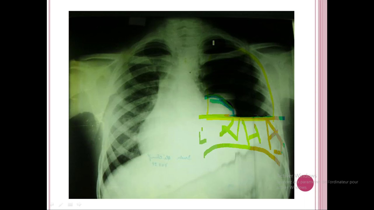 syndrome pleural 02