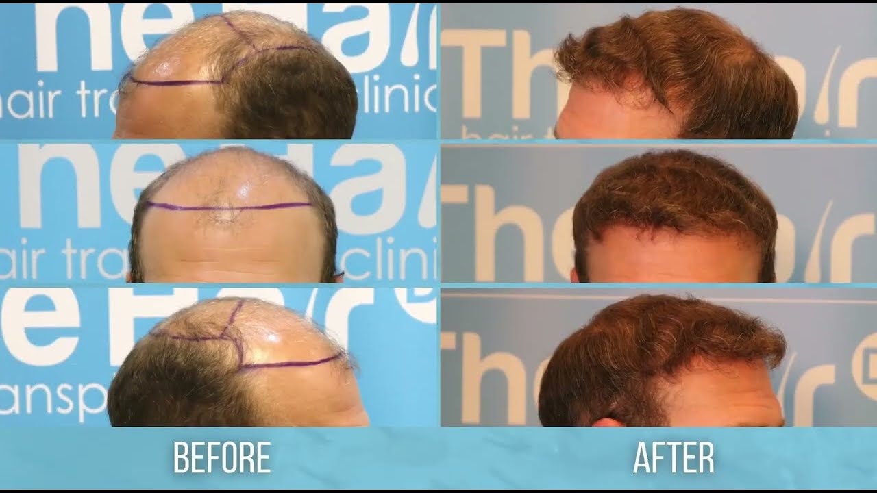 Sam's Hair Transplant Journey by Dr Arshad