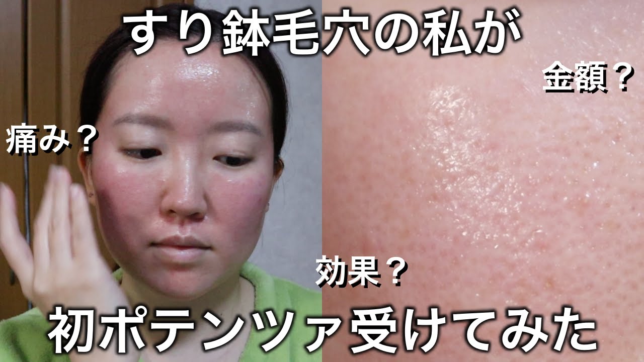 【すり鉢毛穴】初めてダーマペンの進化版ポテンツァを受けてきました！金額•施術の流れ•痛み•効果•所要時間について詳しくお話しします！