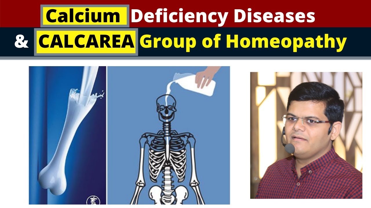 Calcium deficiency diseases & study of Calcarea Group of Homeopathy by Dr. Shoaib Sabir