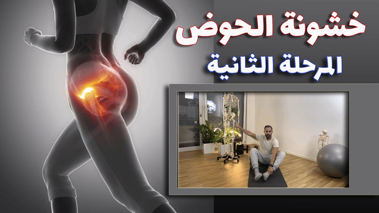 علاج خشونة مفصل الحوض - خشونة مفصل الحوض - المرحلة الثانية