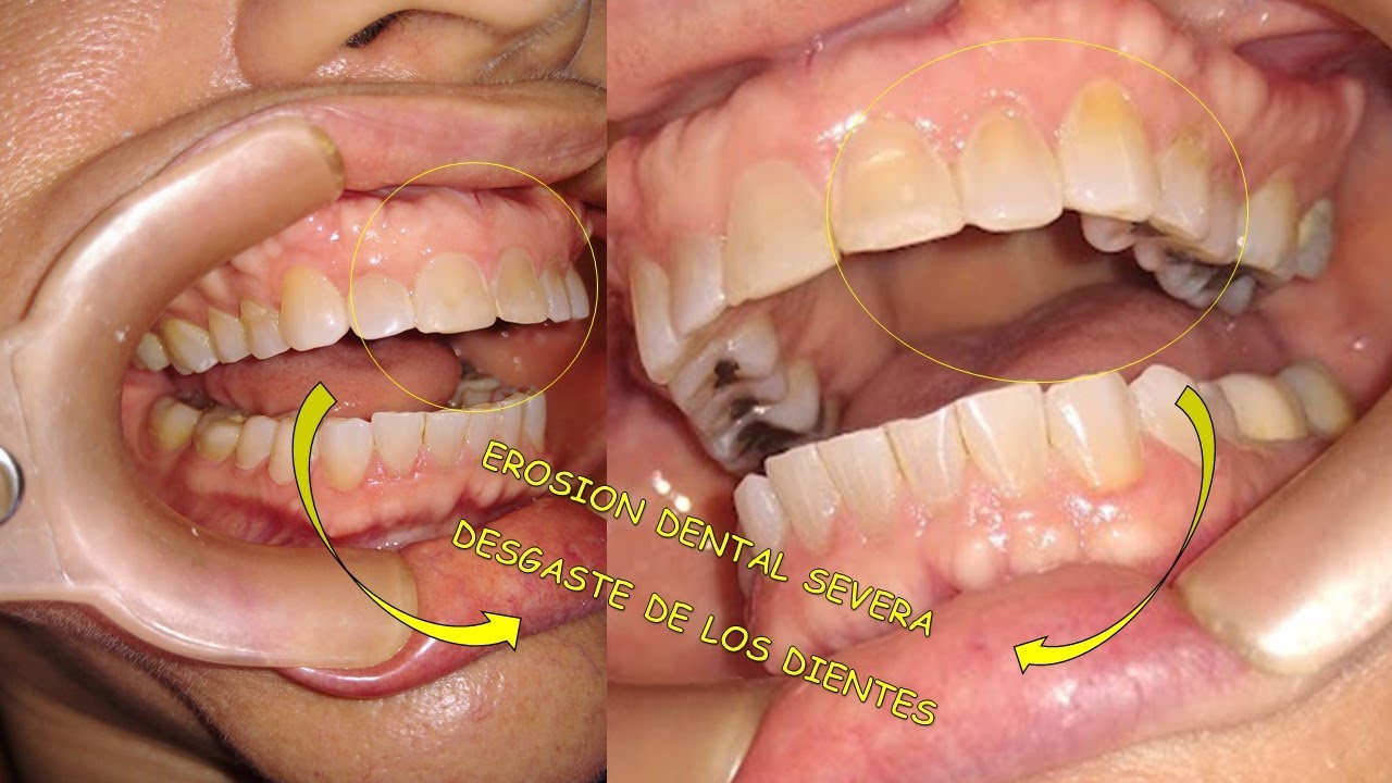 Las bebidas gaseosas destruyen los dientes, 🥤mira esto! Que no te pase! 👀
