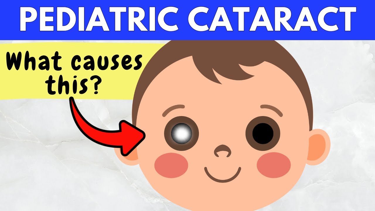 Pediatric Cataracts Explained (what parents need to know)