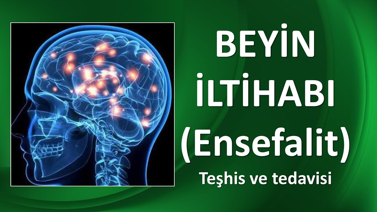 ENSEFALİT BEYİN İLTİHABI TEŞHİS VE TEDAVİSİ