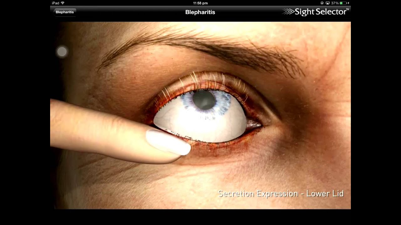 Blepharitis