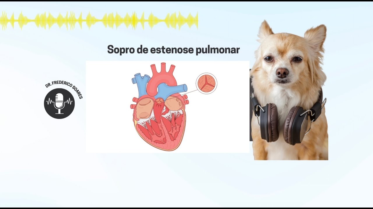 Sopro de estenose pulmonar | EP. 17