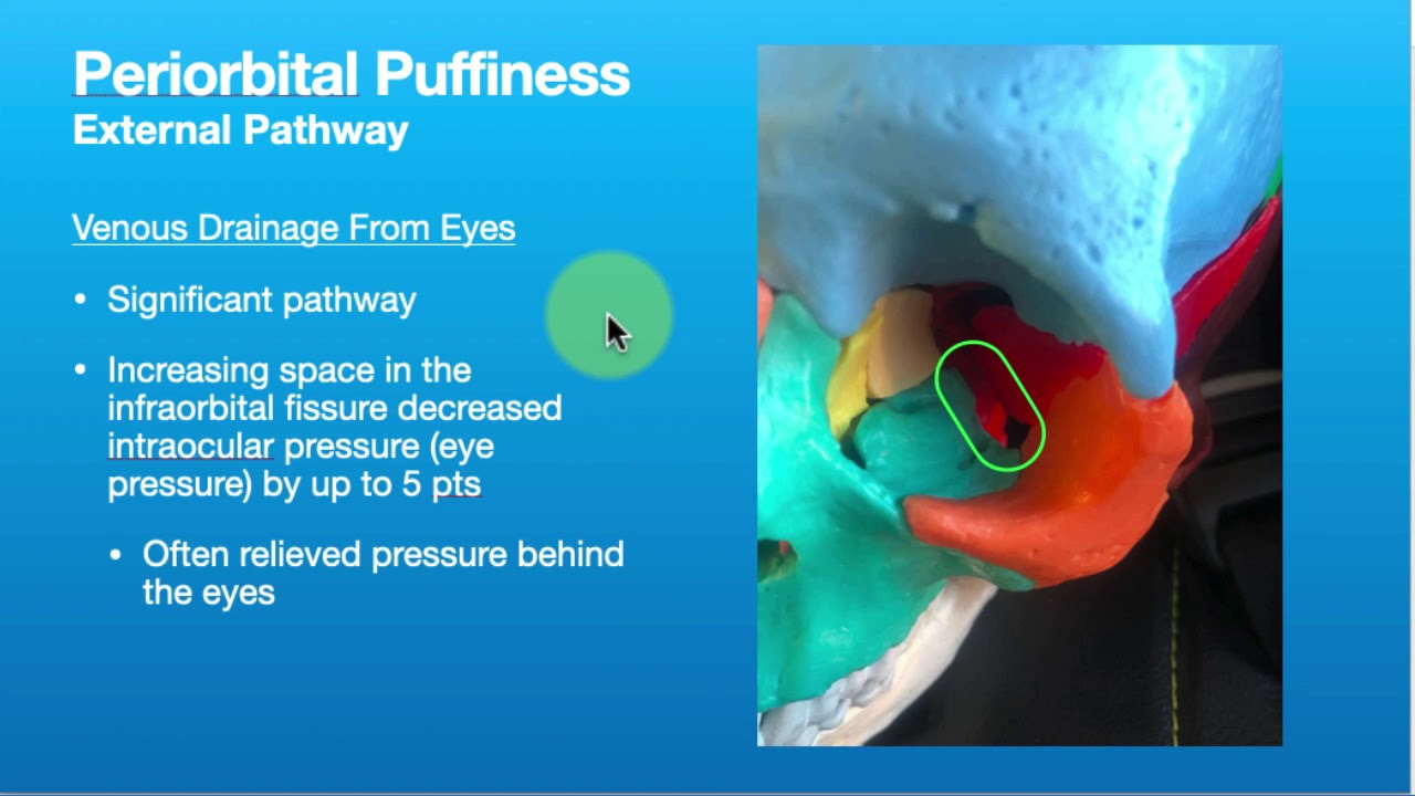 How We Get Bags Under Eyes (Periorbital Puffiness)
