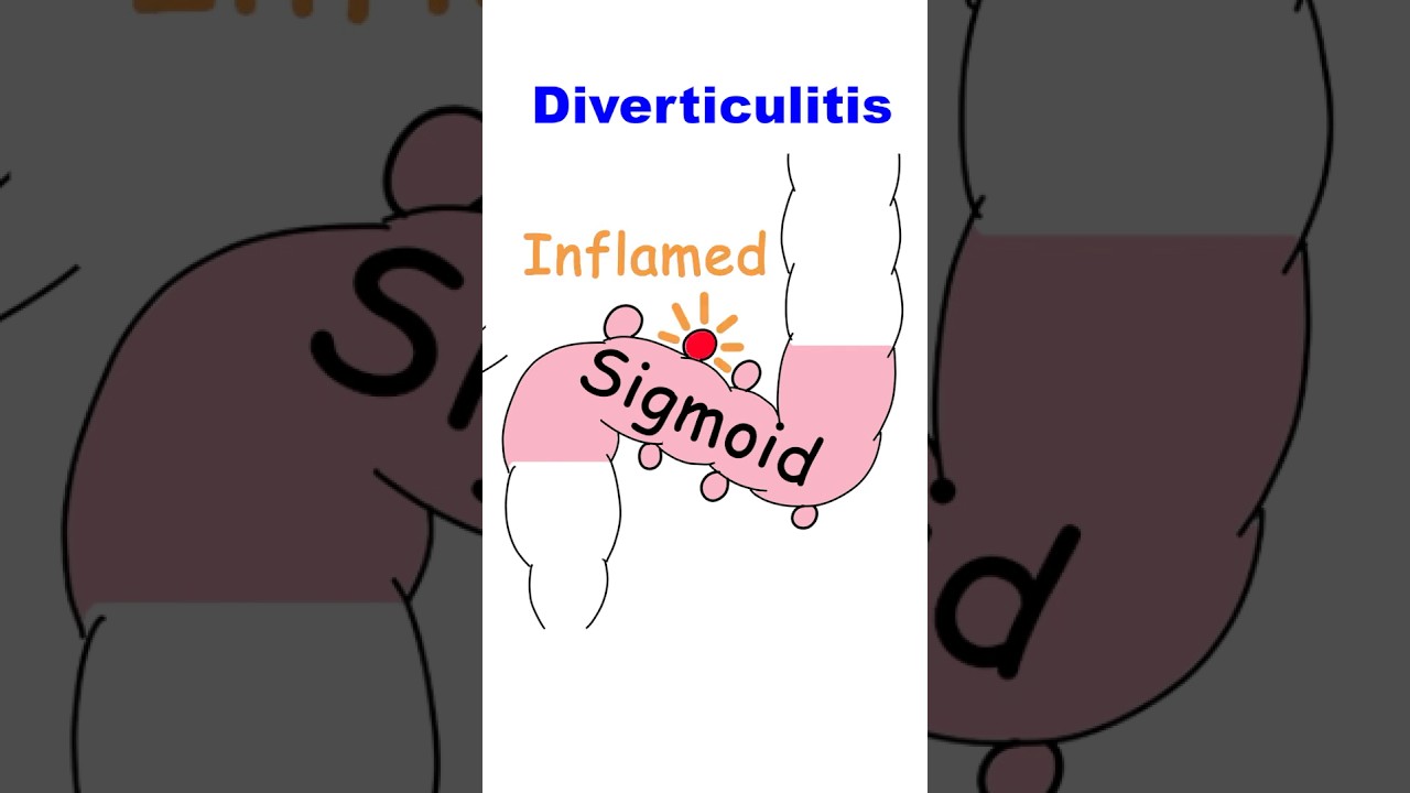 Diverticulitis explained in under 60 seconds #colon #doctor #diverticulitis