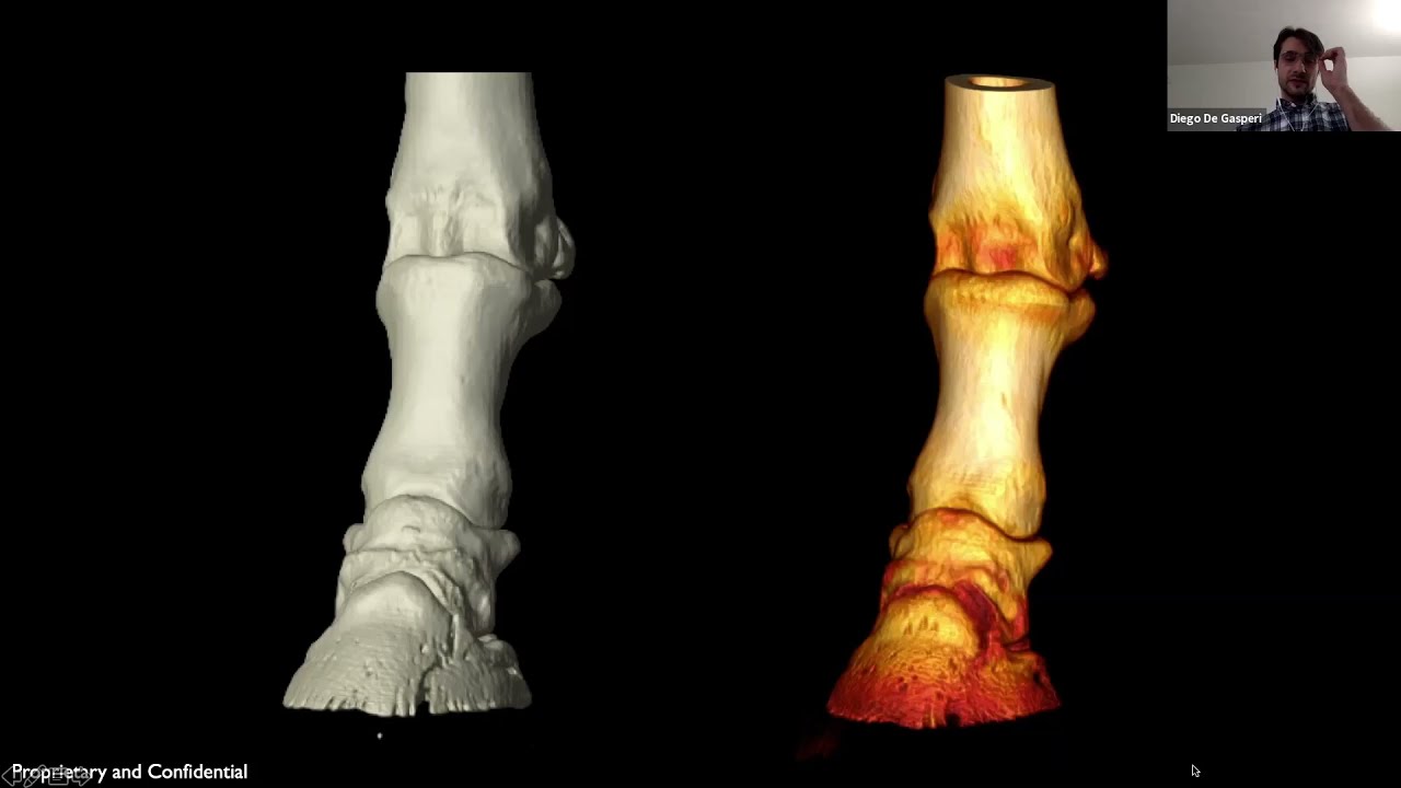 P3 Fracture with Lesions