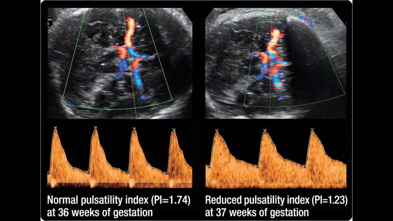 Middle Cerebral Artery Doppler : OG Capsule