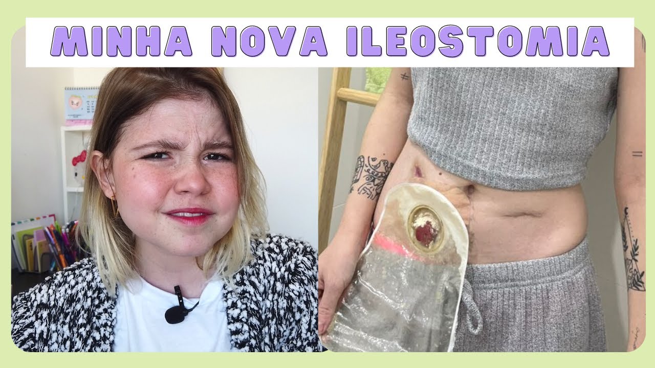 DIFERENÇAS DE ILEOSTOMIA PARA COLOSTOMIA