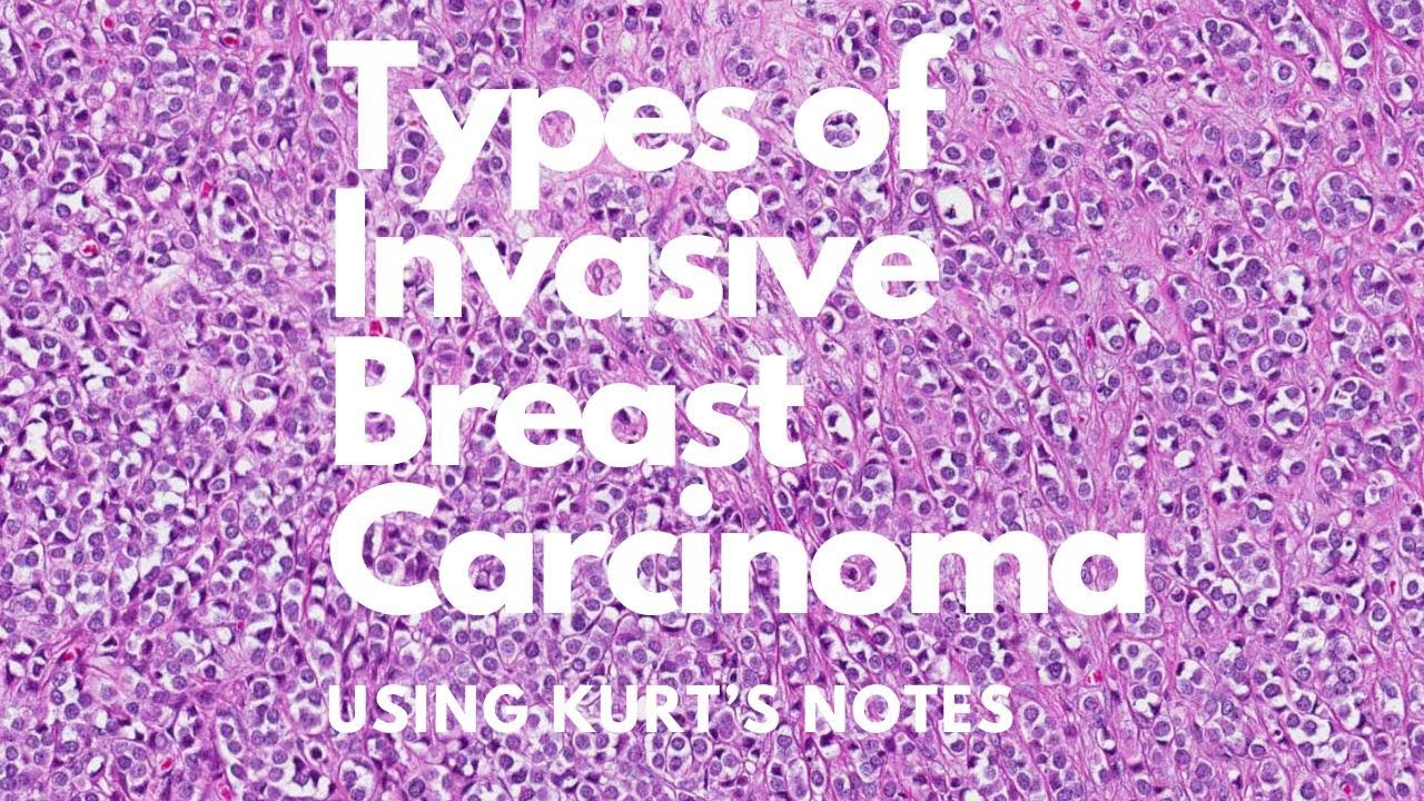 Types of Invasive Breast Carcinoma: Kurt’s Notes #pathagonia