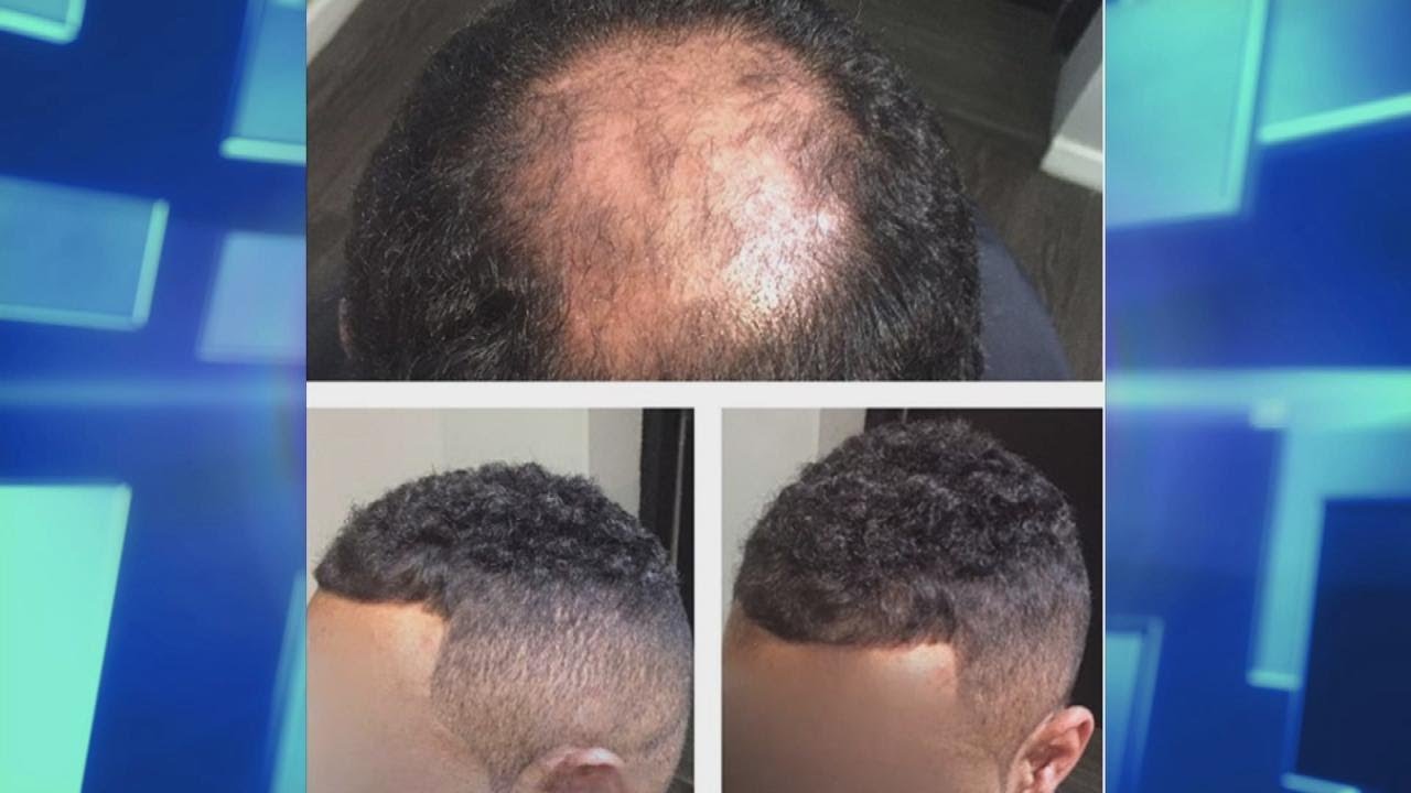 Is a &lsquo;Man Weave&rsquo; a Solution for Going Bald?