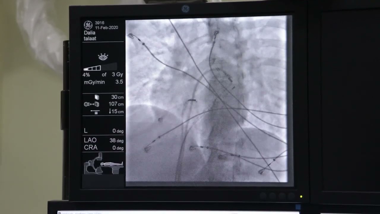 Successful ablation of Concealed left lateral accessory Pathway by trans septal approach