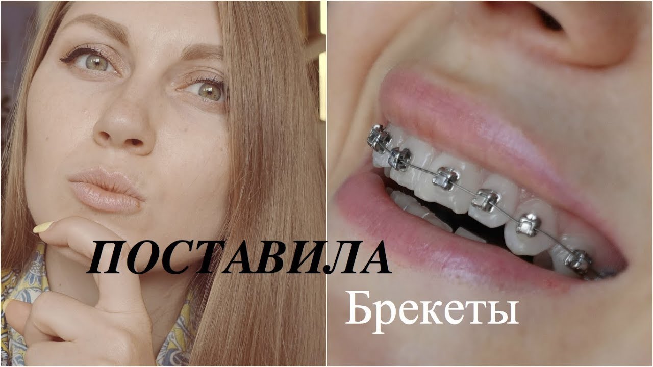 ТЕПЕРЬ Я ТАКАЯ// ВСЕ О БРЕКЕТАХ// МОЙ ОПЫТ